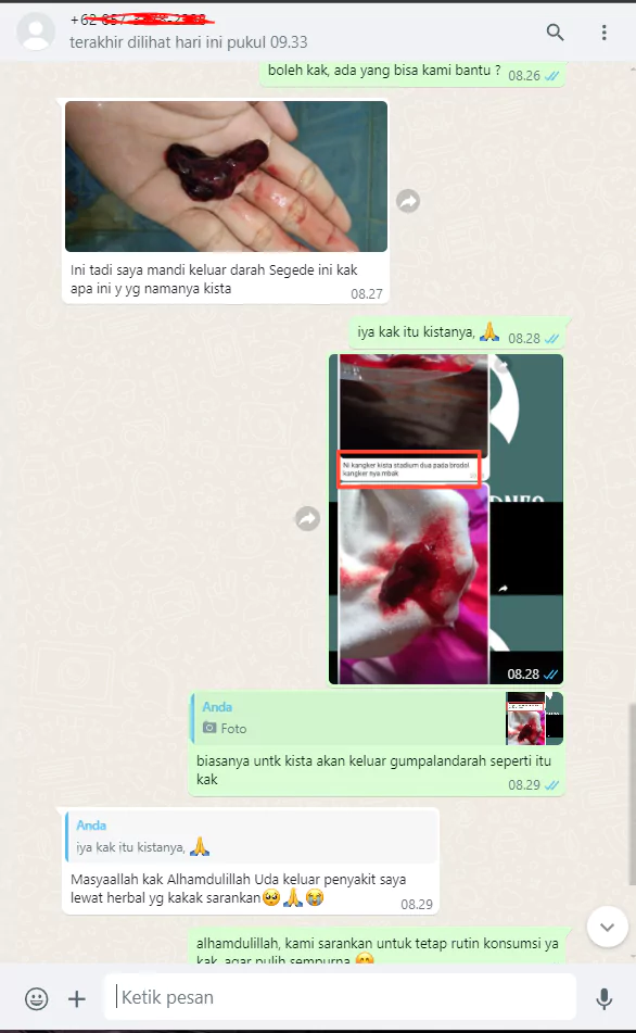 kista-keluar-gumpalan-681057a6c6099